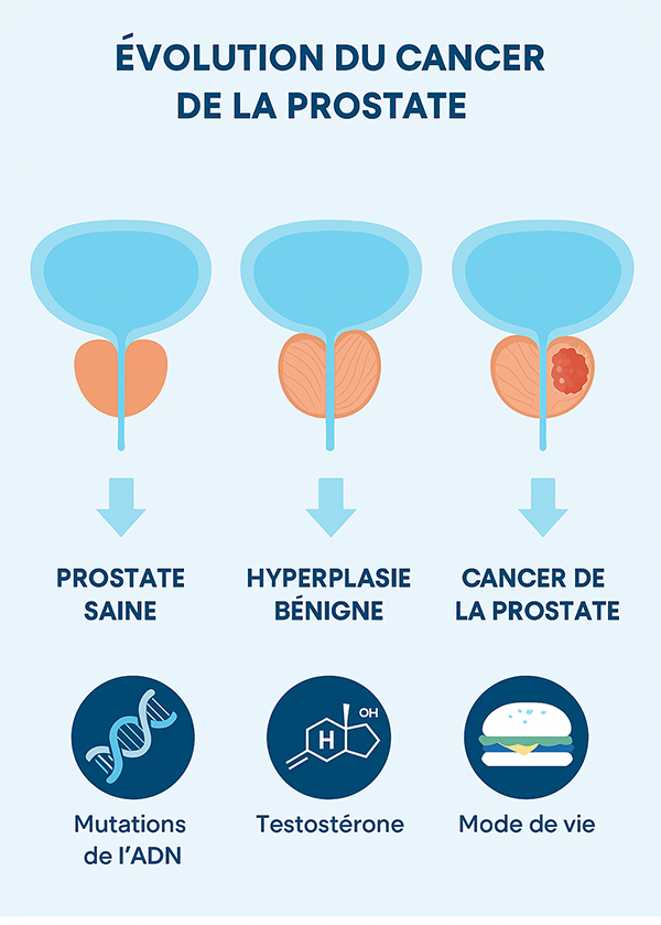 cancer-de-la-prostate-comprendre-la-maladie-pour-mieux-la-combattre